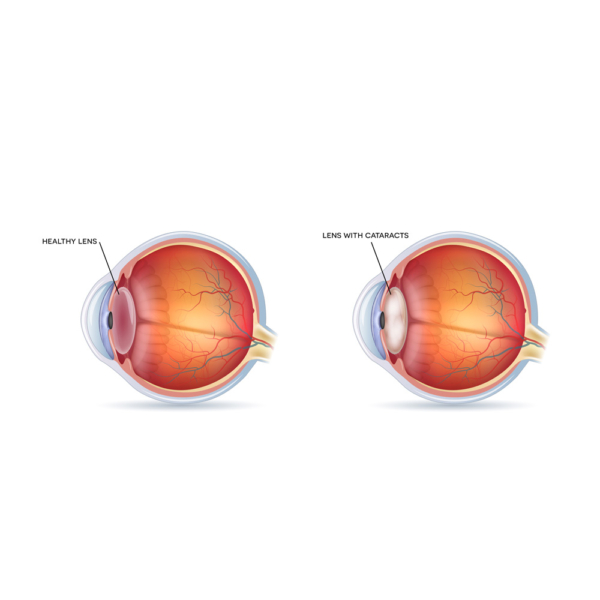 Cataracts Surgery in NYC - New York Medical & Surgical Eye Care