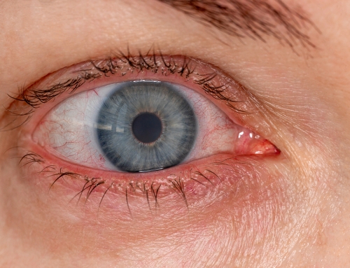 What is Conjunctivitis?