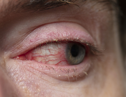 Blepharitis Treatments in New York with Dr. Valeria Rubinstein