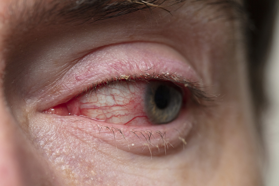 Blepharitis